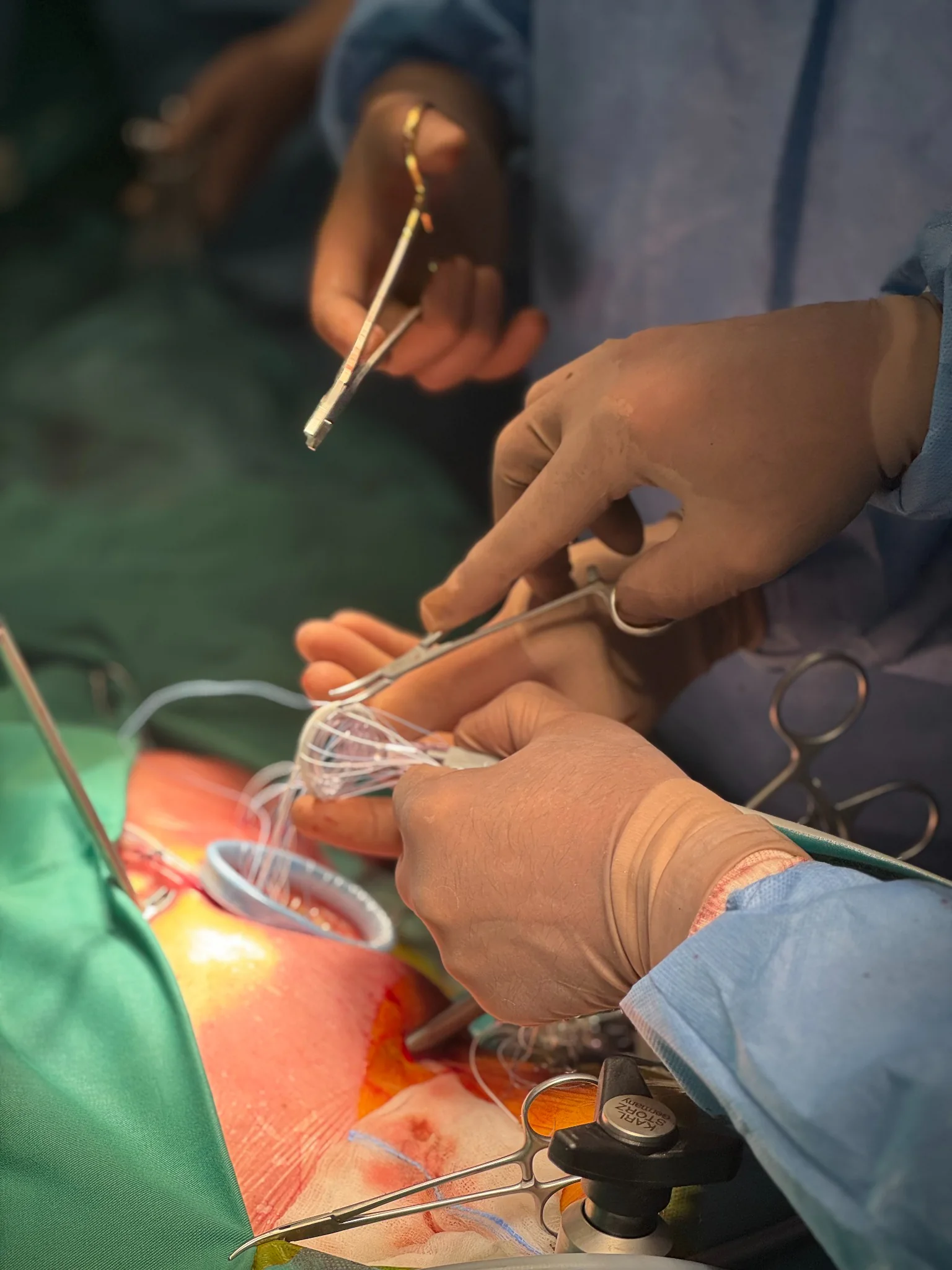 Имплантация на ринг за митрална анулопластика